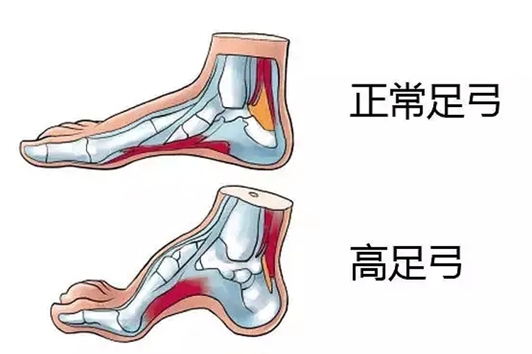 孩子高足弓怎么办